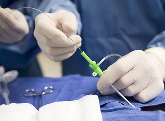 Ablazione con radiofrequenza