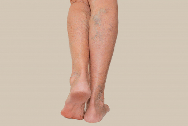 vene varicose sulle gambe