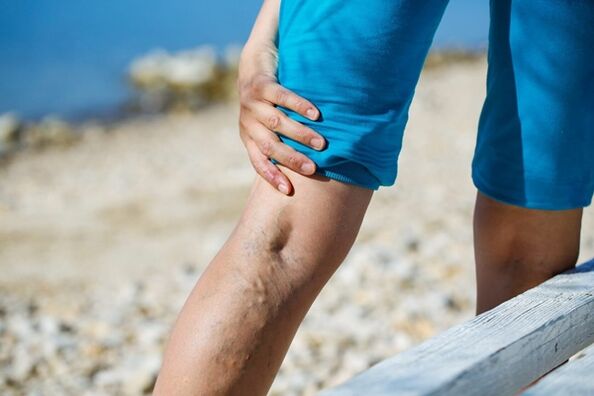 Dolore fastidioso alle gambe con vene varicose