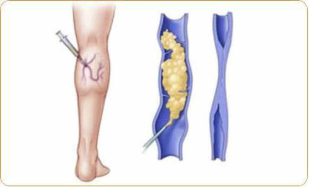 Un esempio della procedura di scleroterapia per le vene varicose e un risultato chiaro